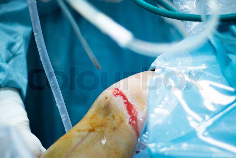 Knee arthroscopy orthopedic surgery operation in hospital operating room photo showing surgeon with arthroscopy camera and probe, stock photo