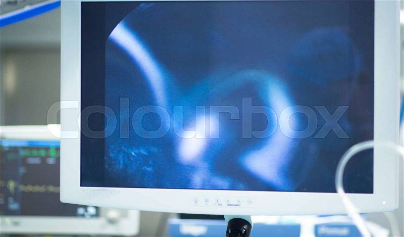 Hospital keyhole micro surgery arthroscopy operation screen showing arthroscope camera internal body image photo, stock photo