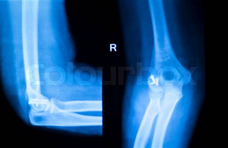 Othopedics and Traumatology surgical implant arm and elbow xray test scan results showing titanium metal plate and screws, stock photo