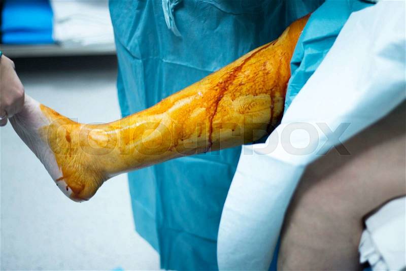 Knee arthroscopy orthopedic surgery operation in hospital emergency operating room sterilization of leg photo, stock photo