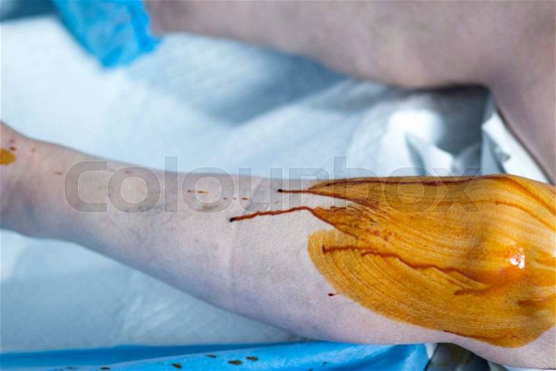 Nurse sterilizing leg for orthopedic knee surgery in hospital emergency operating room photo, stock photo