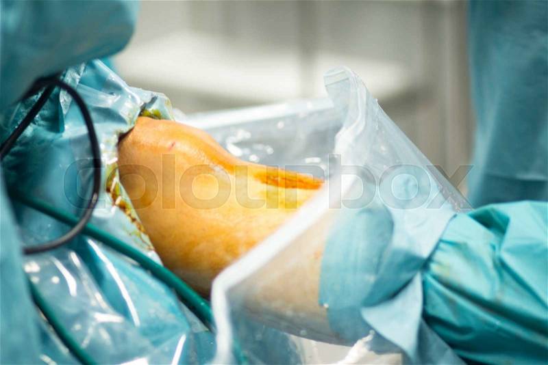 Orthopedic surgery meniscus operation hospital emergency operating room photo, stock photo