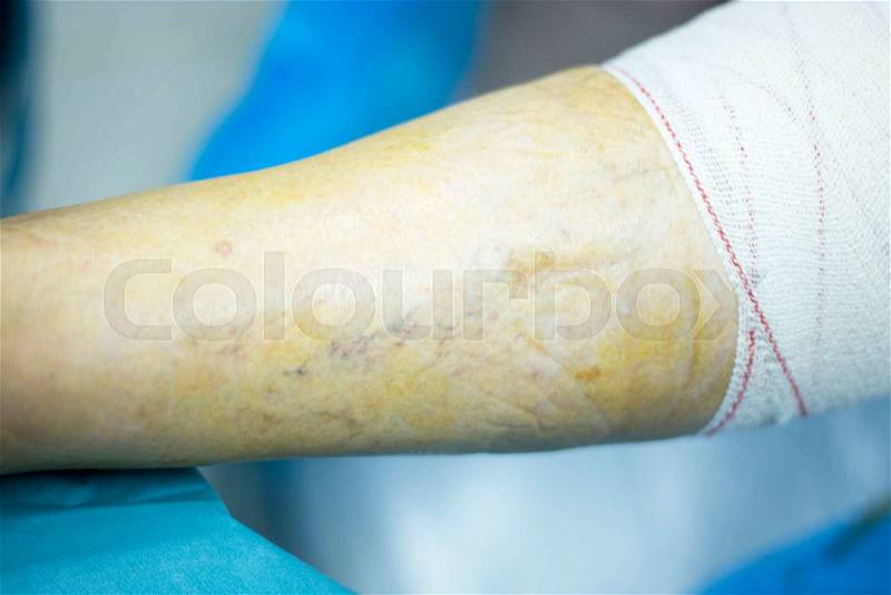Knee arthroscopy orthopedic surgery operation in hospital emergency operating room photo, stock photo