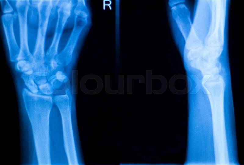 Othopedics and Traumatology surgical implant arm and elbow xray test scan results showing titanium metal plate and screws, stock photo