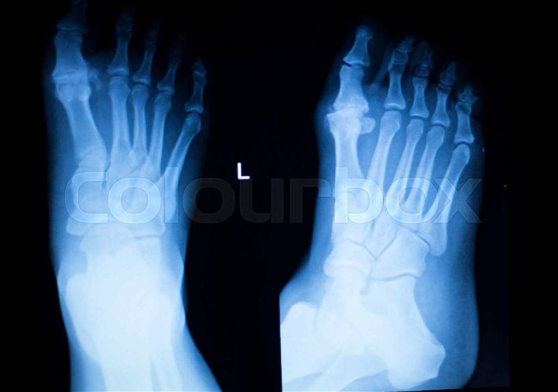 Foot and toes injury x-ray scan orthopedics and Traumatology radiology test results photo, stock photo