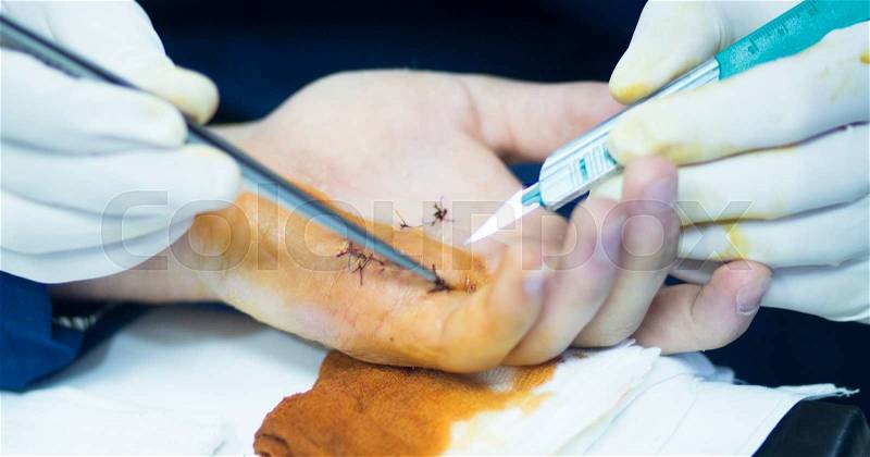 Hospital hand surgery orthopedics operation photo, stock photo