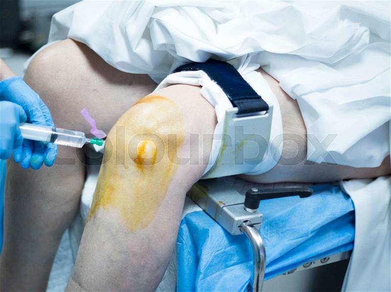 Knee arthroscopy orthopedic surgery operation in hospital emergency operating room sterilization of leg photo, stock photo