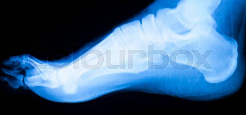 Foot and toes injury x-ray scan orthopedics and Traumatology radiology load bearing test results photo, stock photo