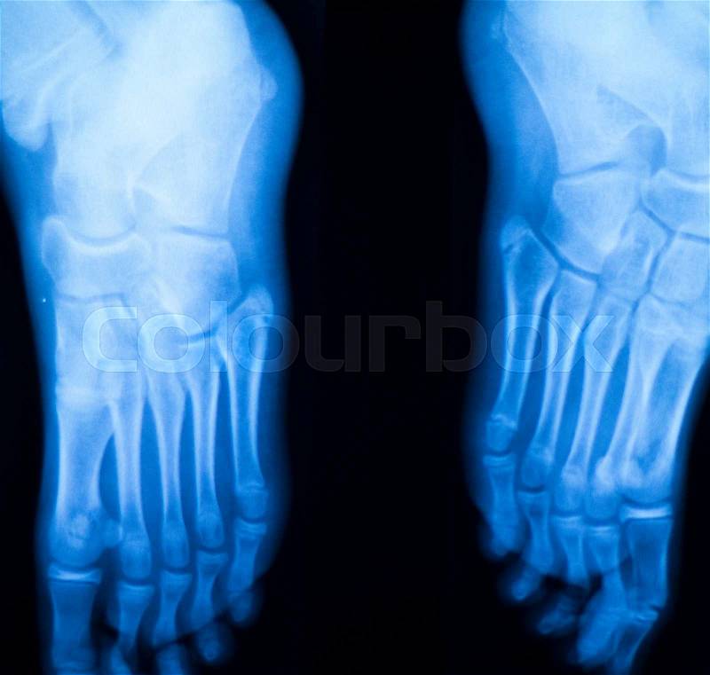 Foot and toes injury x-ray scan orthopedics and Traumatology radiology test results photo, stock photo
