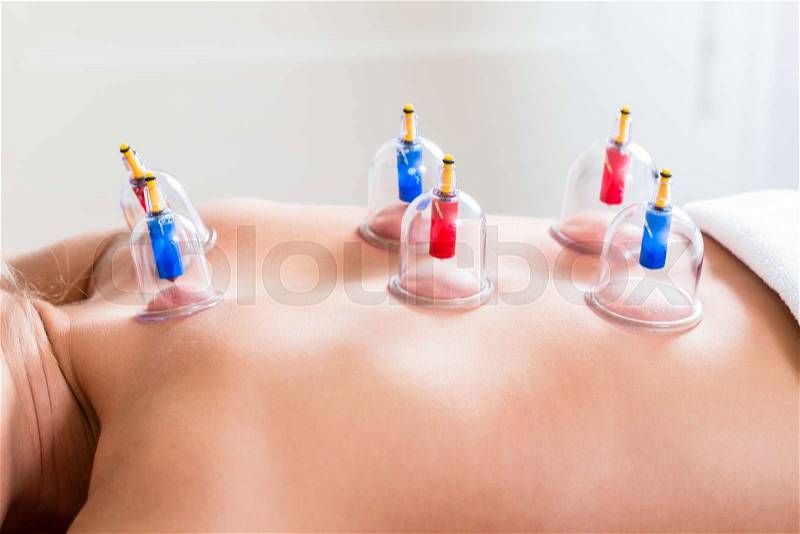 Alternative practitioner cupping woman in course of alternative therapy treatment, stock photo