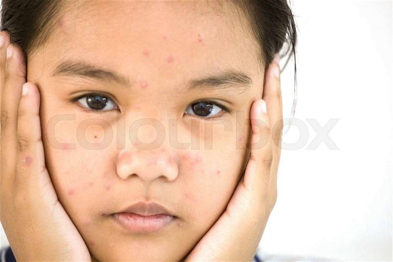Portrait of teen to unhappy with chickenpox on face , stock photo