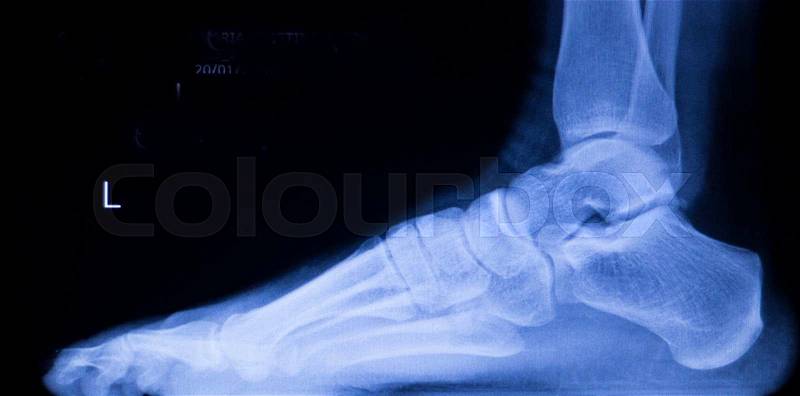 Foot and toes injury Traumatology medical x-ray Orthopedic test scan image, stock photo