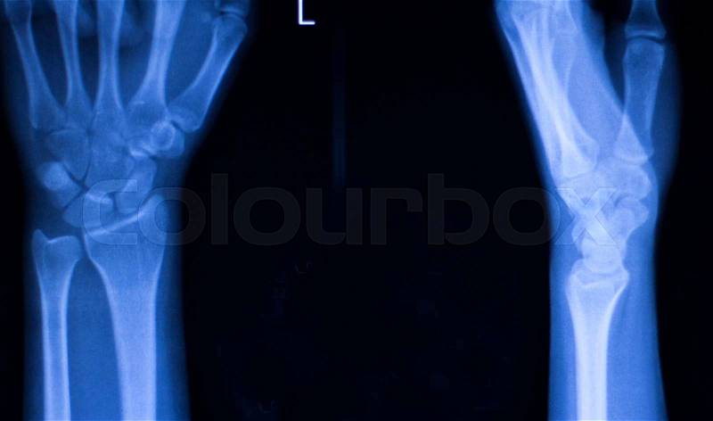Hand, fingers, thumb and wrist injury orthopedic Traumatology medical x-ray test scan image, stock photo