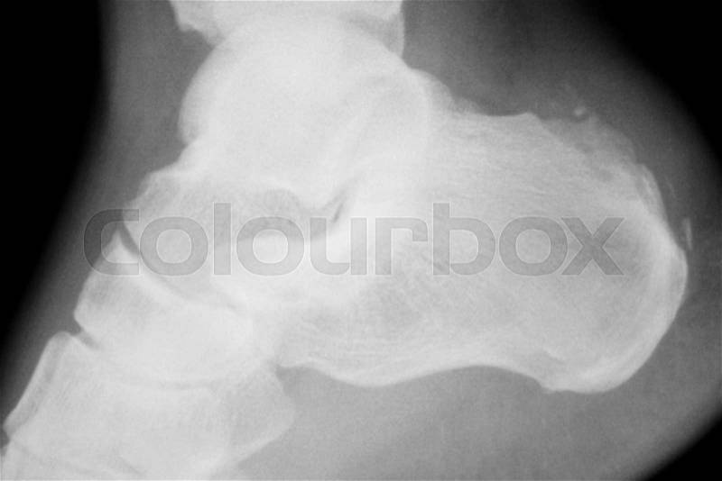 Foot heel and ankle injury Traumatology medical x-ray Orthopedic test scan image, stock photo