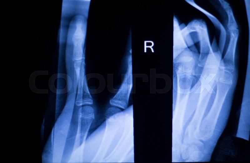 Forearm, arm and elbow injury xray scan test reults to diagnose pain source, stock photo