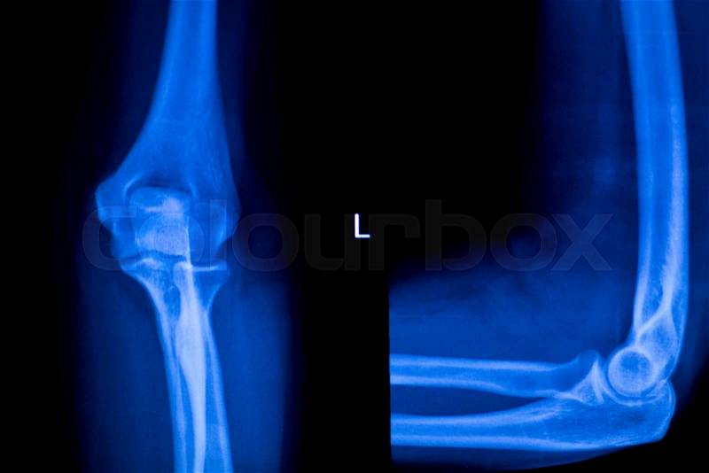 Forearm, arm and elbow injury xray scan test reults to diagnose pain source, stock photo