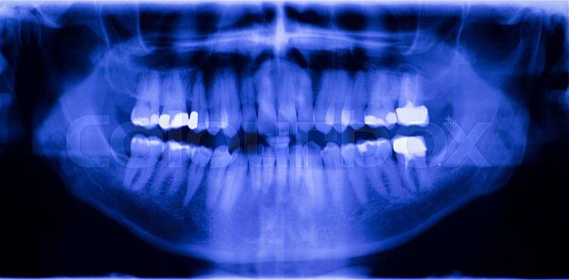 Dental teeth fillings, gum disease gingivitis dentists medical tooth x-ray test scan image, stock photo