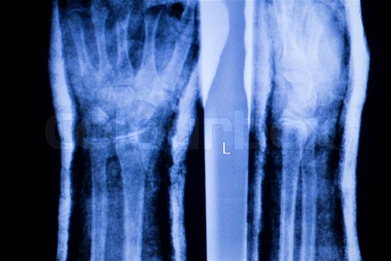 Forearm, arm and wrist injury xray scan test reults to diagnose pain source, stock photo