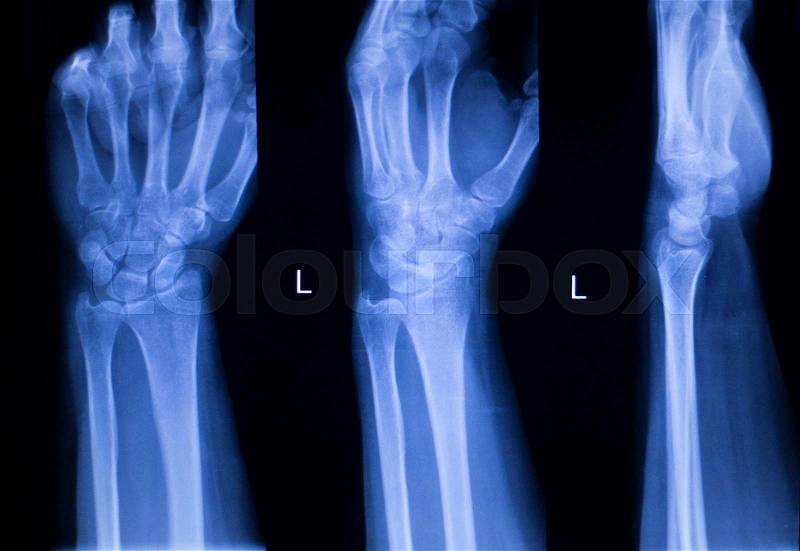 Hand, fingers, thumb and wrist injury orthopedic Traumatology medical x-ray test scan image, stock photo