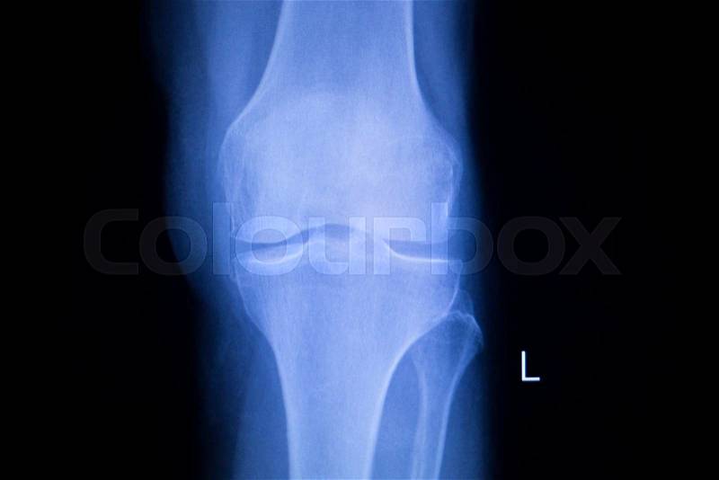 Knee and meniscus injury medical x-ray test scan result image, stock photo