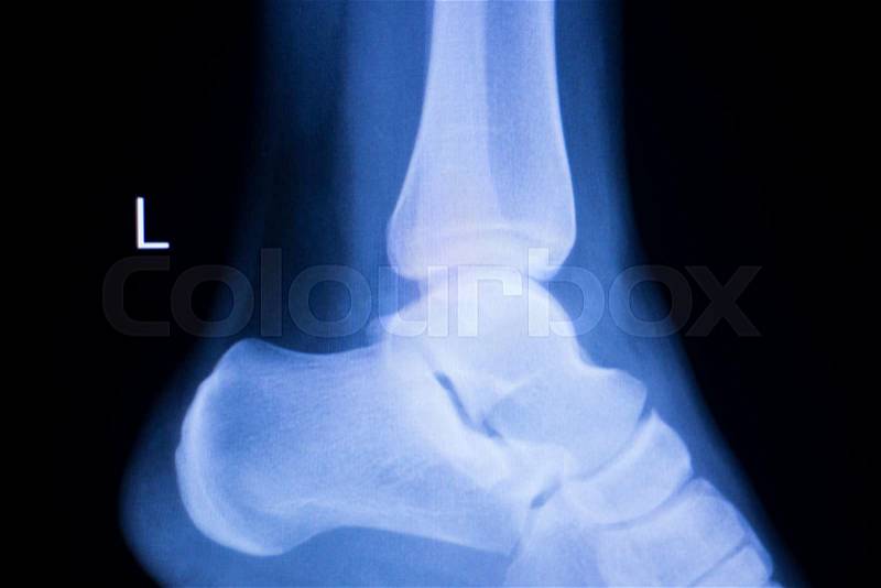 Foot heel and ankle injury Traumatology medical x-ray Orthopedic test scan image, stock photo