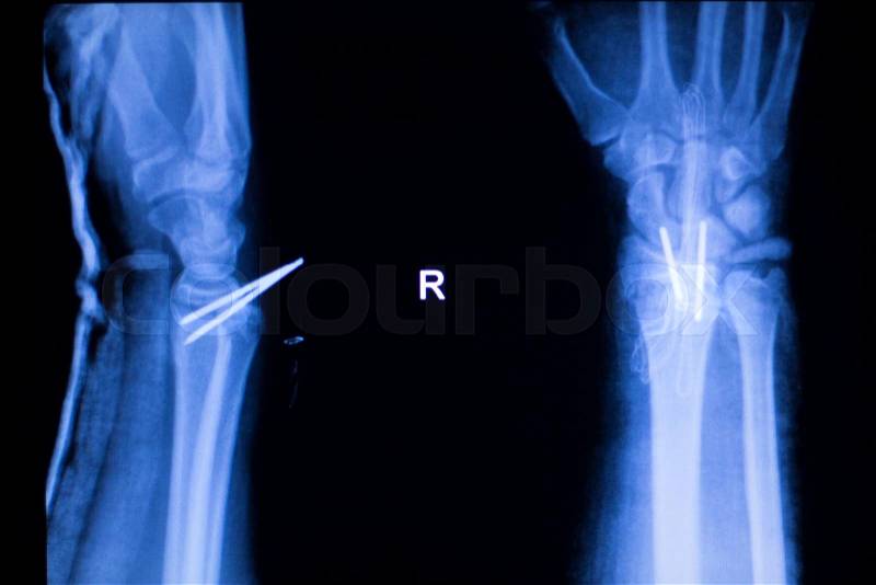 Forearm orthopedic titanium metal replacement implant xray scan test results, stock photo