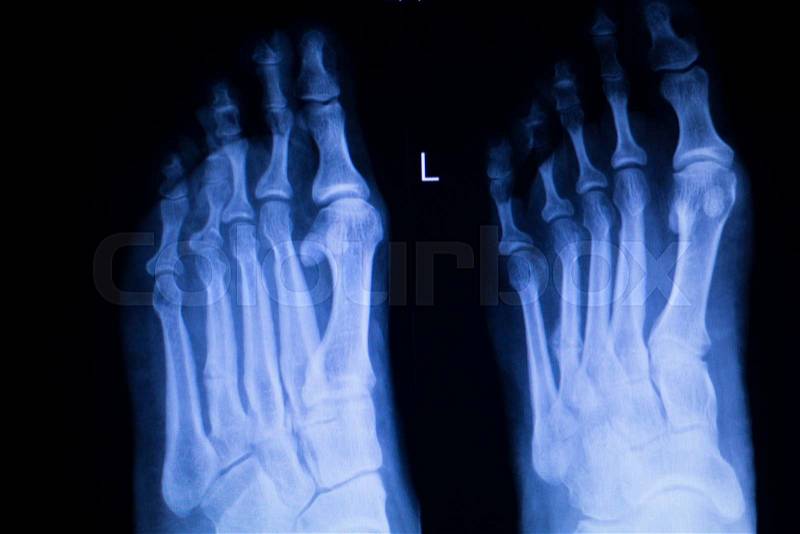 Foot and toes injury Traumatology medical x-ray Orthopedic test scan image, stock photo