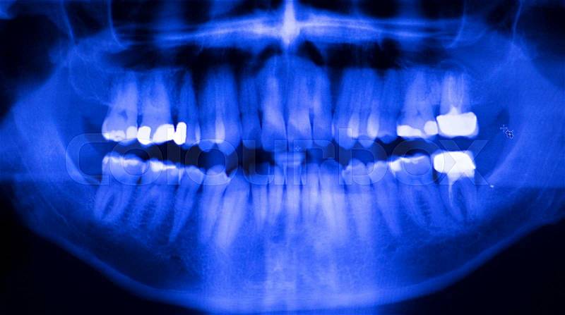 Dental teeth fillings, gum disease gingivitis dentists medical tooth x-ray test scan image, stock photo