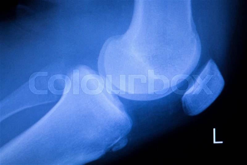 Knee and meniscus injury medical x-ray test scan result image, stock photo