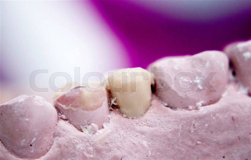 Dental prosthetics clay tooth mold in dentists laboratory photo, stock photo