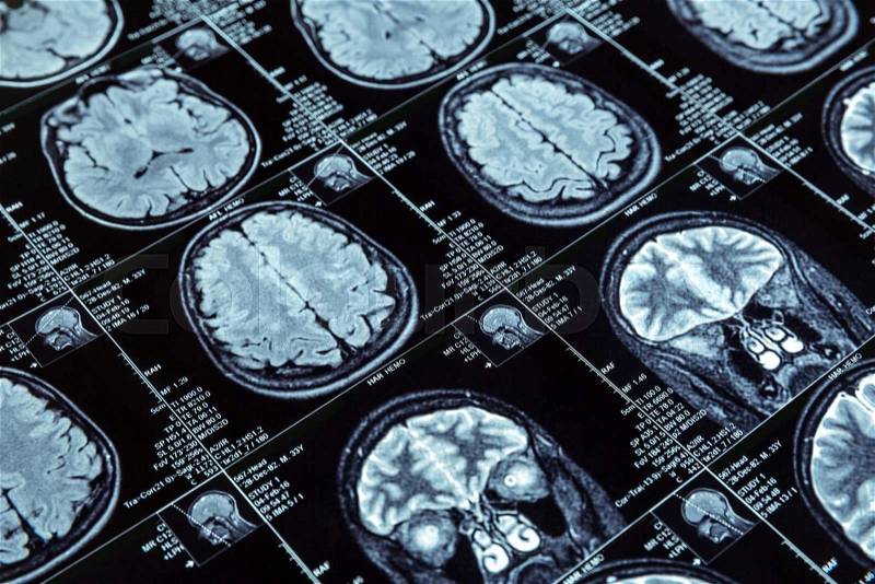 Closeup of magnetic resonance imaging photography of human brain , stock photo