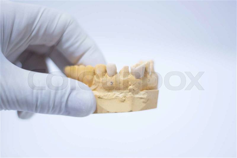 Dentists' dental teeth prosthetic mould in clinic, stock photo