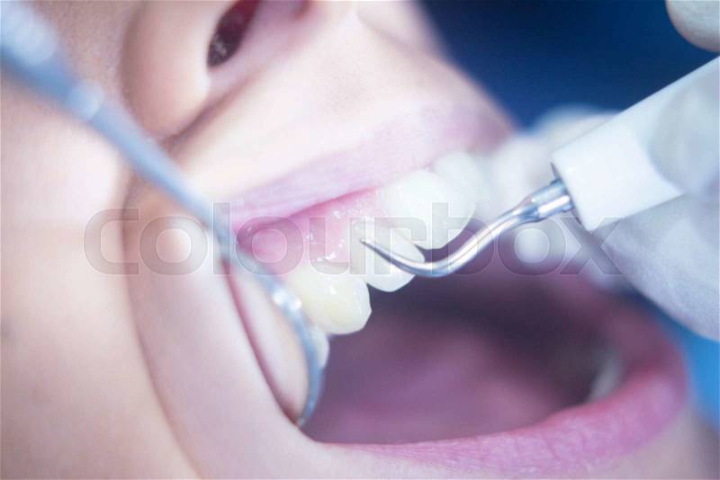 Dentist examining patient mouth in dental exam cleaning with dentist\'s instrumentation in clinic, stock photo