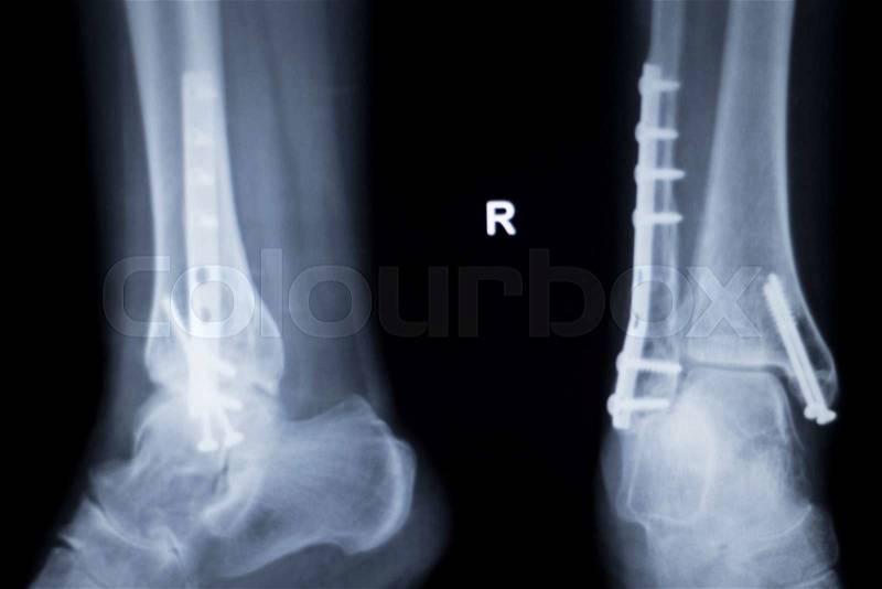 Ankle and leg injury medical x-ray test scan result for adult showing orthopedic Traumatology titanium metal plate and screw implant image, stock photo