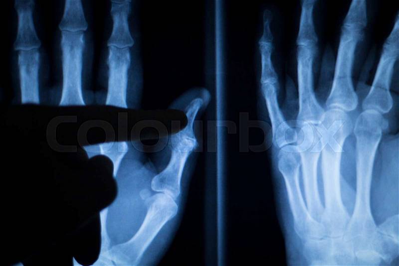 Wrist, hand injury medical x-ray test scan result for adult image, stock photo