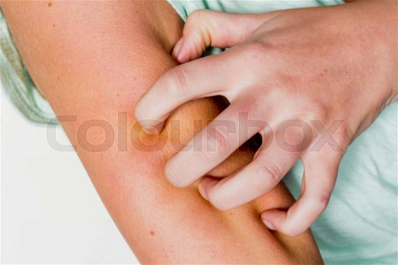 A woman has to a mosquito bite an itchy skin and scratches, stock photo