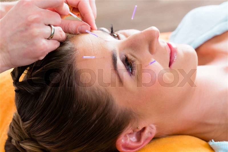 Therapist setting acupuncture needles on woman in course of acupuncture treatment, stock photo