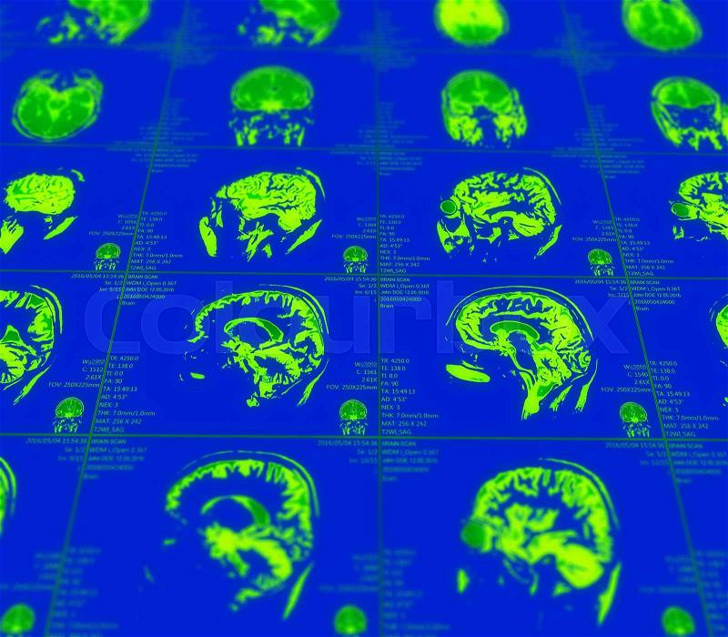 Magnetic resonance imaging of the brain with no visible abnormalities. MRI in different views, stock photo