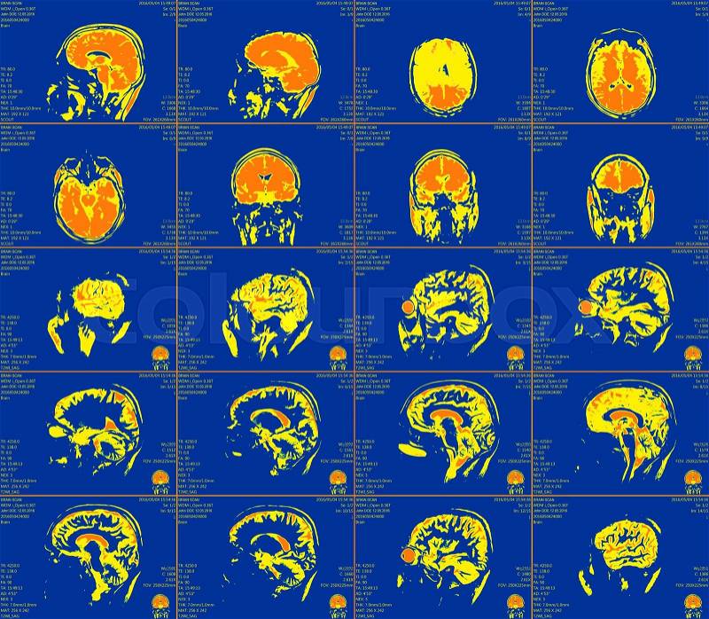 Magnetic resonance imaging of the brain with no visible abnormalities. MRI in different views, stock photo