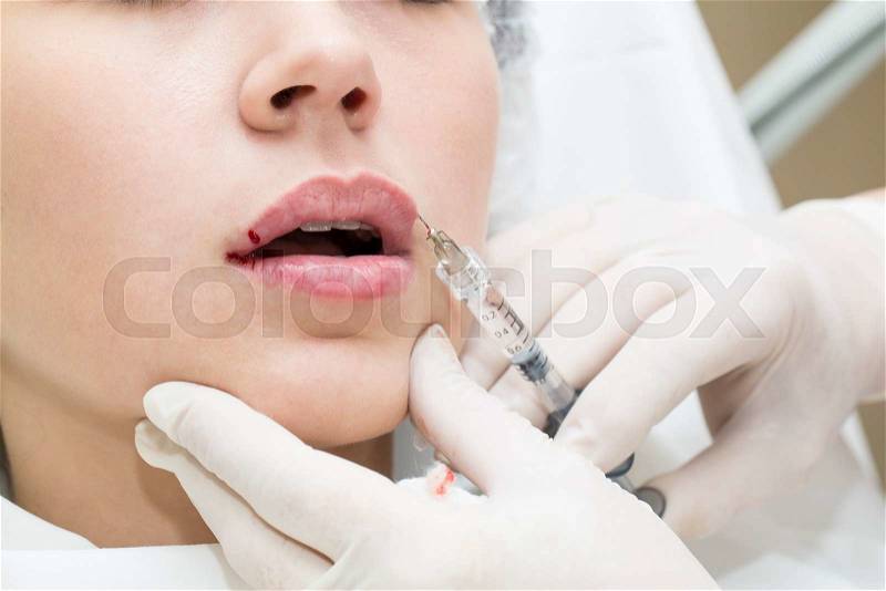 Young girl in a clinic contour lips procedure, stock photo