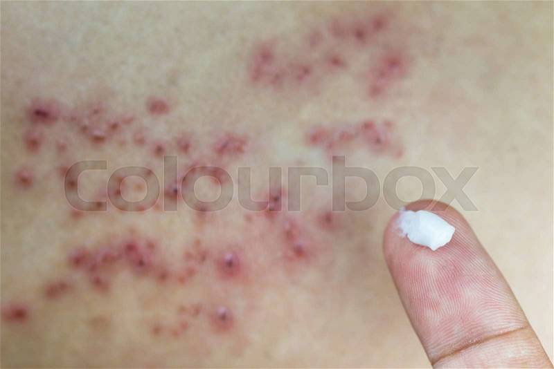 Raised red bumps and blisters on skin with white cream on finger, stock photo