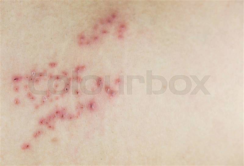 Raised red bumps and blisters on skin, stock photo