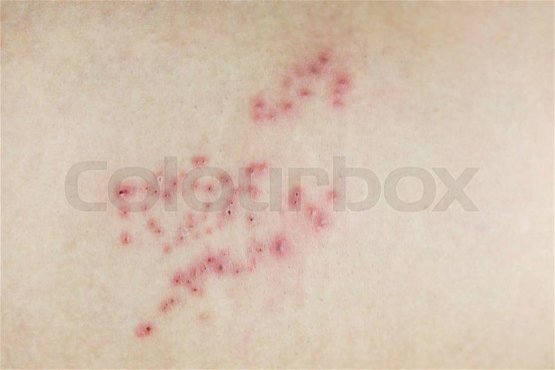 Raised red bumps and blisters on skin , stock photo