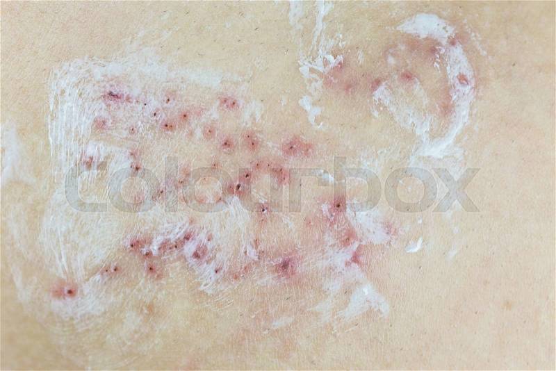 Raised red bumps and blisters on skin with white cream selective focus on finger , stock photo