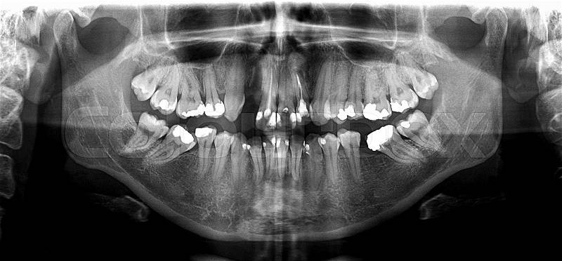 X ray of human mouth with teeth bones in black and white, stock photo