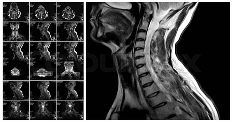 Magnetic resonance imaging of the cervical spine. MRI vertebral discs in different views, stock photo