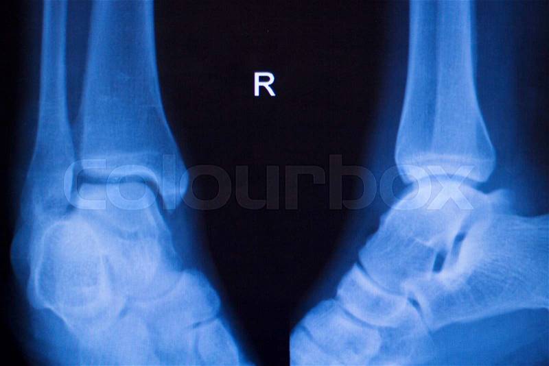 Foot, heel and ankle xray traumatology and orthopedics test medical scan used to diagnose sports injuries, stock photo