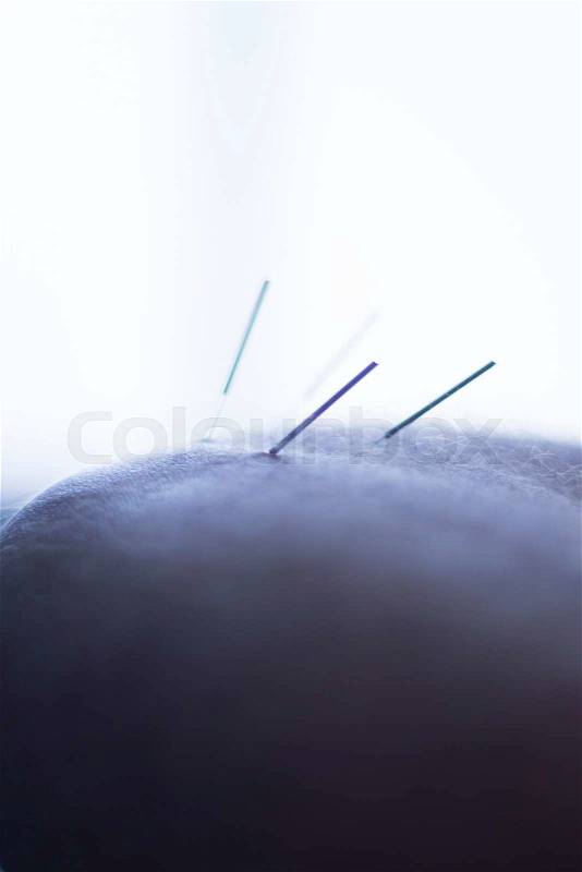 Dry needling acupunture needles used by acupunturist physiotherapist on patient in pain and injury treatment closeup macro hoto, stock photo