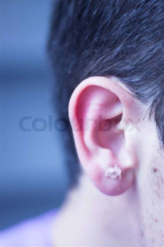 Auriculartherapy oriental acupunture ear seed sticker plaster auriculatherapy treatment physiotherapy. Physiotherapist in hospital clinic,, stock photo