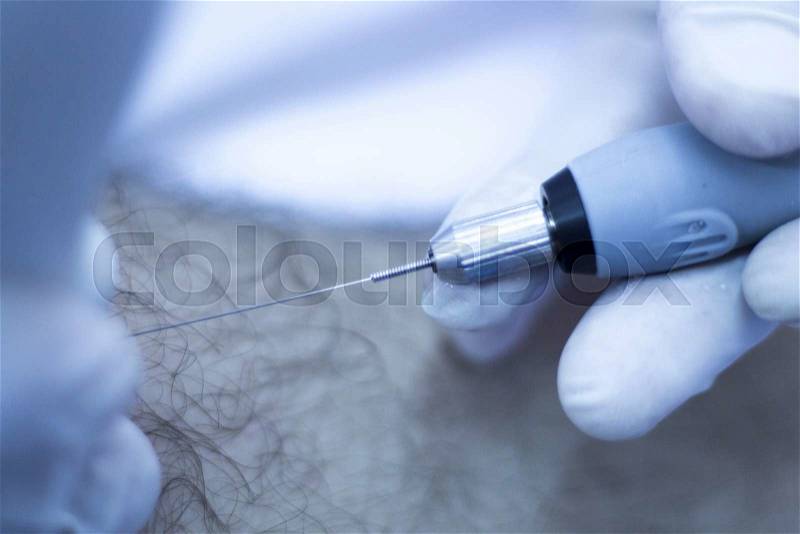 Electroacupunture dry needling needle connecting machine to needles used by acupunturist on patient for acupunture guided by EPI Intratissue Percutaneous Electrolisis, stock photo